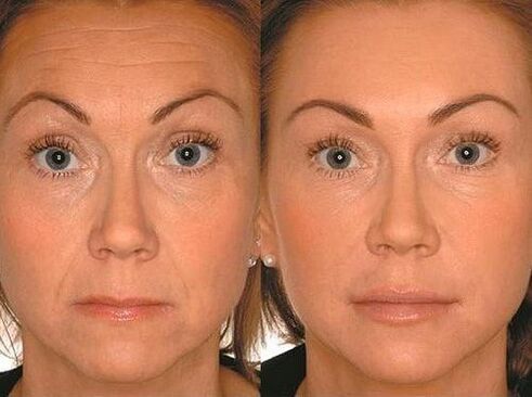 Before and after microcurrent therapy