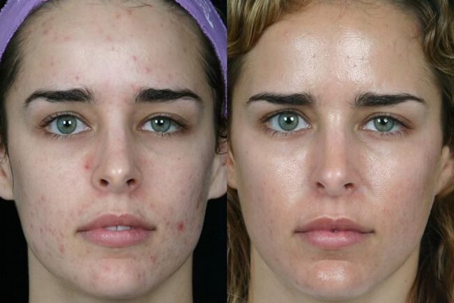 Laser grind of facial skin before and after