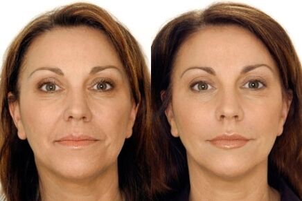 Lpg massage of face before and after